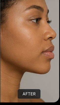 Jawline Sculpting after